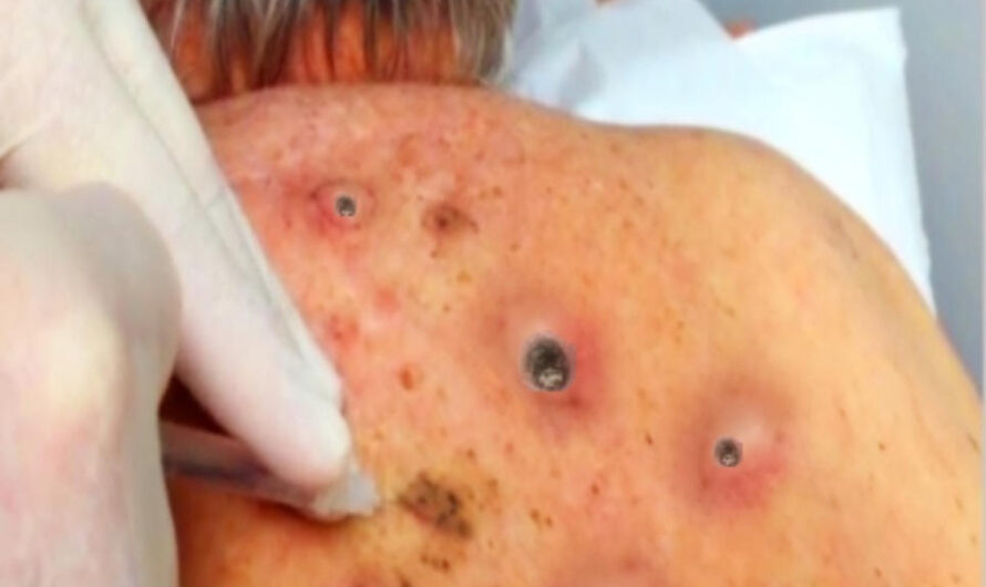 The Best Video of Acne #149
